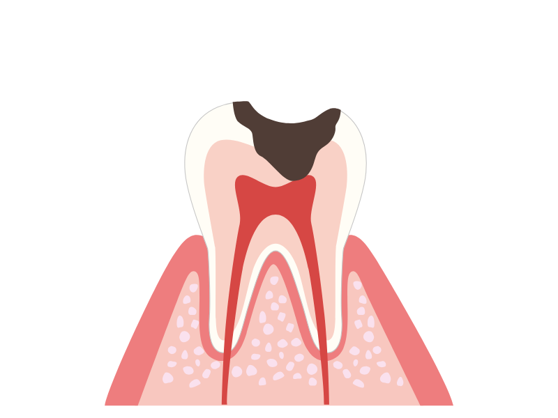 むし歯リスク上昇