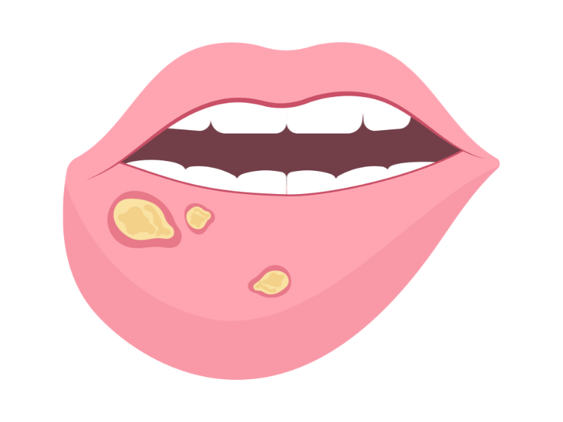 リスク3. 口内炎などができやすい