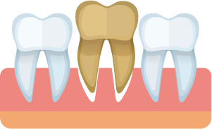 特定の歯への負担