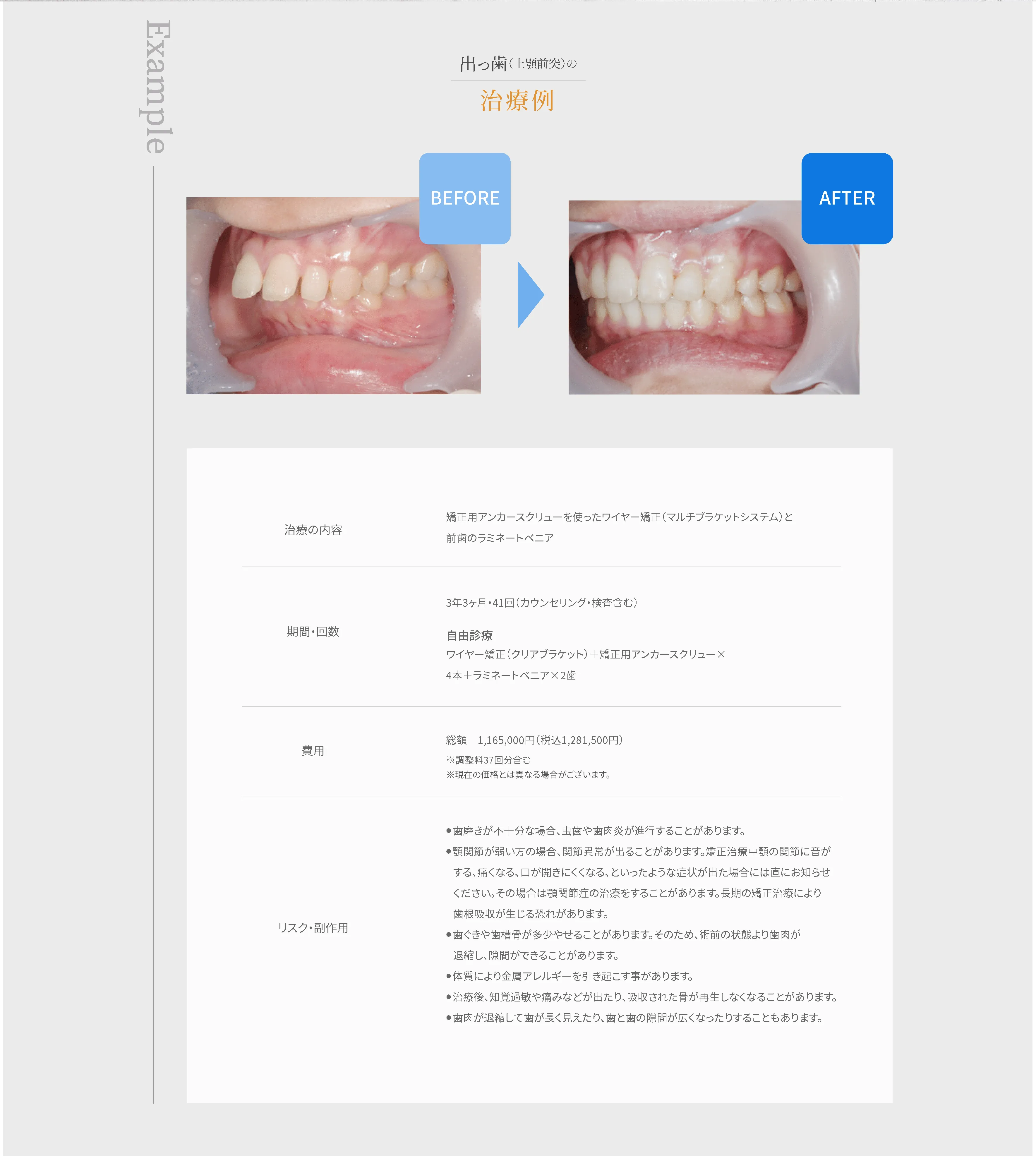 出っ歯（上顎前突）の治療例