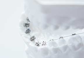 裏側（舌側）矯正の模型