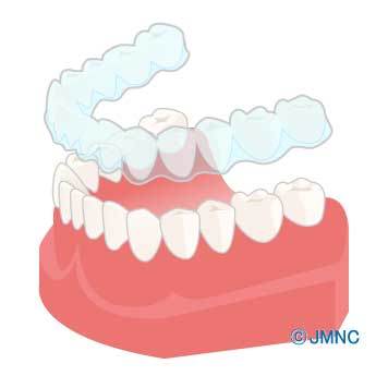マウスピース型矯正装置