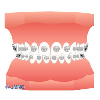 マルチブラケット装置