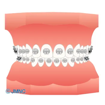 ブラケット矯正