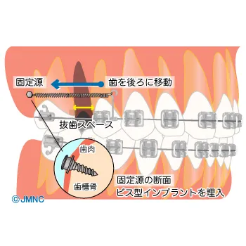 インプラント矯正